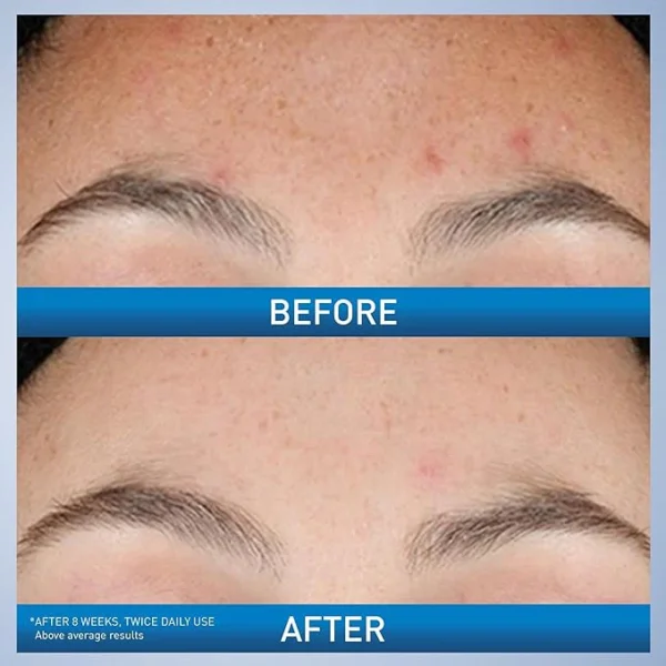 CeraVe Retinol Serum for Post-Acne Marks and Skin Texture - Image 2